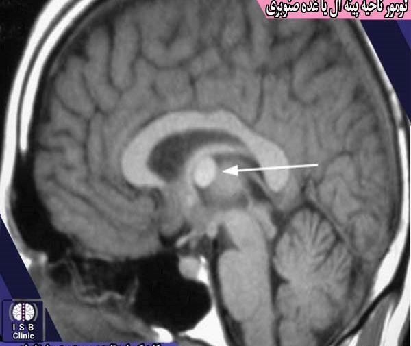عکس غده هیپوفیز در ام ار ای