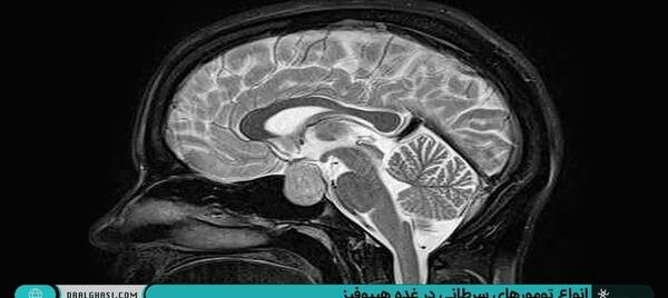 عکس غده هیپوفیز در ام ار ای