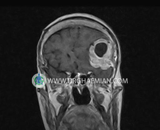 عکس غده هیپوفیز در ام ار ای