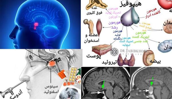 عکس غده هیپوفیز در ام ار ای