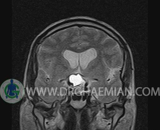 عکس غده هیپوفیز در ام ار ای