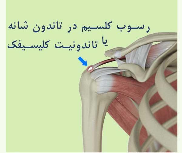 عکس ام ار ای شانه چپ
