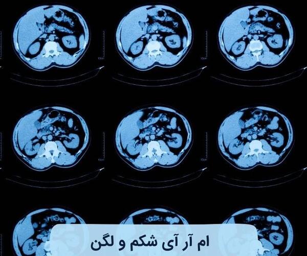 عکس ام آر آی شکم و لگن