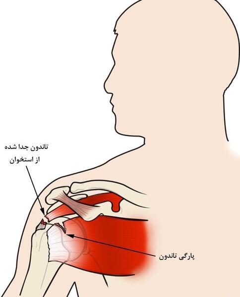 پارگی کتف عکس ام ار ای شانه سالم