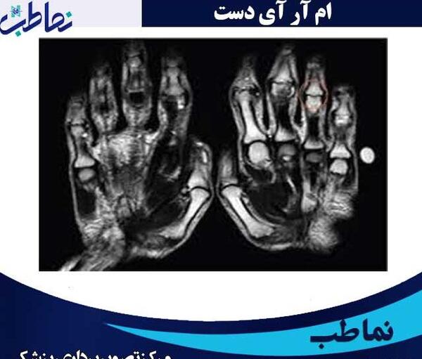 عکس ام ار ای شانه اسیب دیده