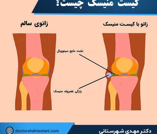 نمونه عکس ام ار ای زانو