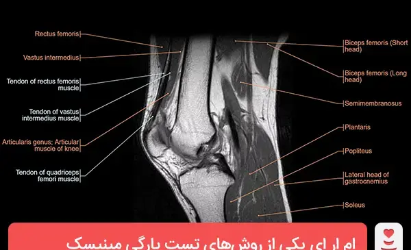 عکس زانو در ام ار ای