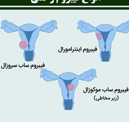 عکس ام ار ای رحم و تخمدان