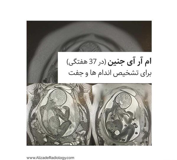 عکس ام ار ای از رحم