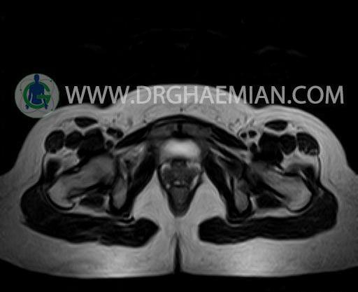 عکس ام ار ای از رحم