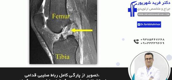 پارگی رباط صلیبی در عکس ام ار ای