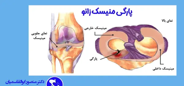 پارگی رباط صلیبی در عکس ام ار ای