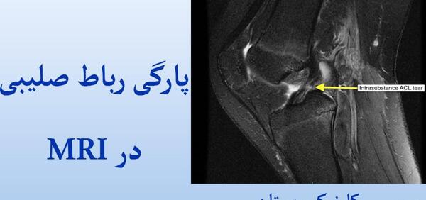 پارگی رباط صلیبی در عکس ام ار ای