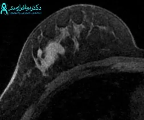 عکس ام ار ای ریه سالم