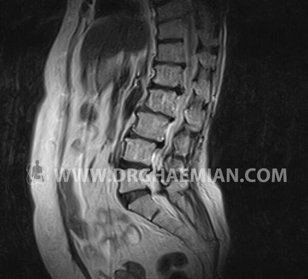 عکس ام ار ای دنبالچه سالم