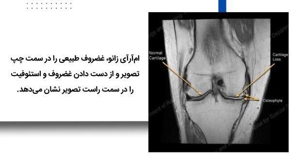خواندن عکس ام ار ای زانو