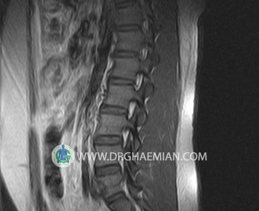 جواب روش خواندن عکس ام ار ای از دیسک کمر