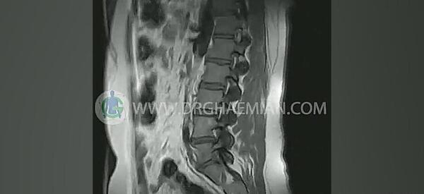 چگونه عکس ام ار ای کمر را بخوانیم