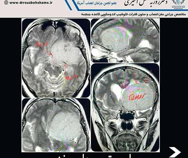 عکس ام آر آی تومور مغزی