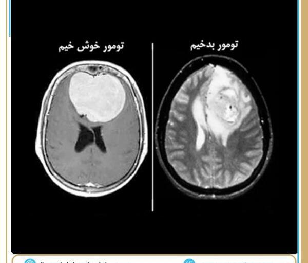 عکس ام آر آی تومور مغزی