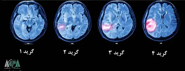 عکس ام آر آی تومور مغزی
