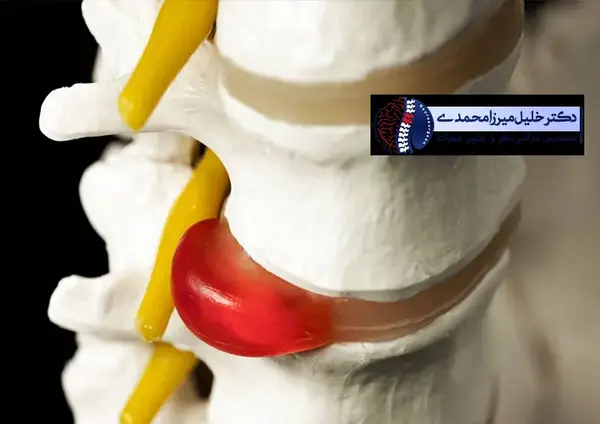 عکس ام ار ای پارگی دیسک گردن