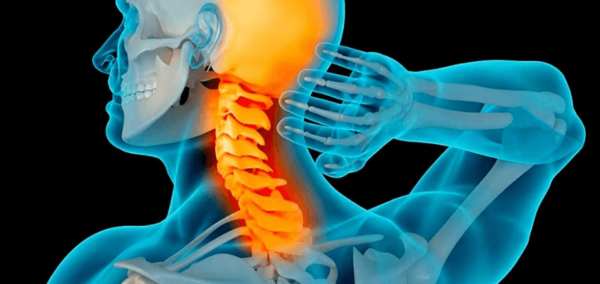 عکس ام ار ای پارگی دیسک گردن