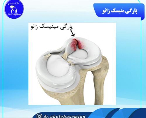عکس ام ار ای پارگی مینیسک
