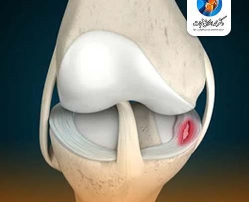 عکس ام ار ای پارگی مینیسک