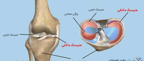 عکس ام ار ای پارگی مینیسک