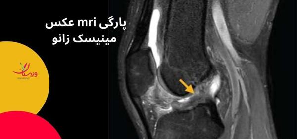 عکس ام ار ای پارگی مینیسک