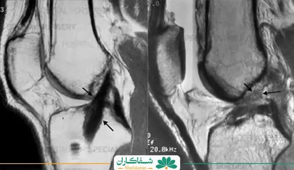 عکس ام ار ای پارگی رباط