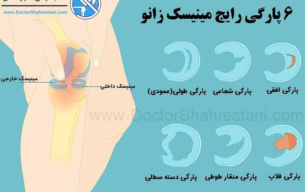 عکس ام ار ای پارگی رباط