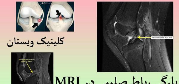 عکس ام ار ای پارگی رباط