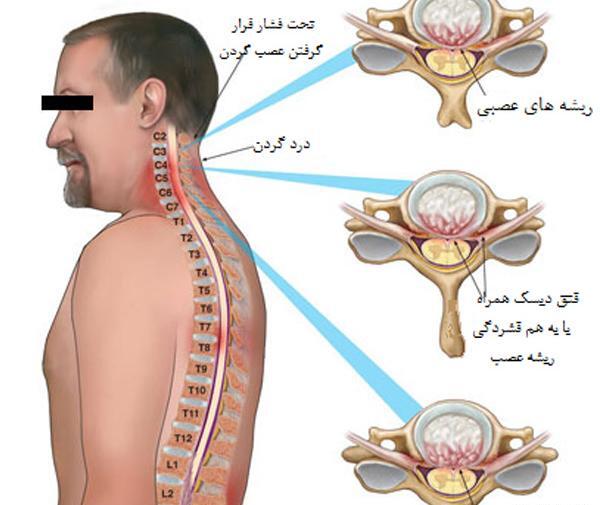عکس ام ار ای دیسک گردن شدید