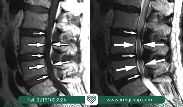 عکس ام ار ای دیسک گردن پاره