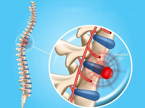 عکس ام ار ای دیسک گردن نی نی سایت