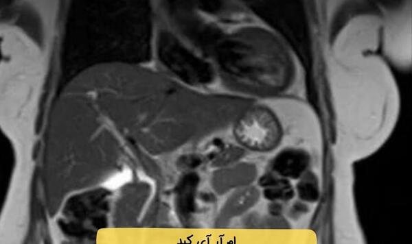 عکس ام ار ای دیسک گردن نی نی سایت