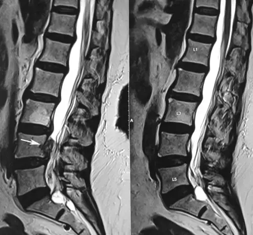 عکس دیسک گردن در ام ار ای