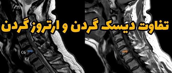 عکس ام ار ای از دیسک گردن