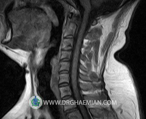 نمونه عکس ام ار ای دیسک گردن