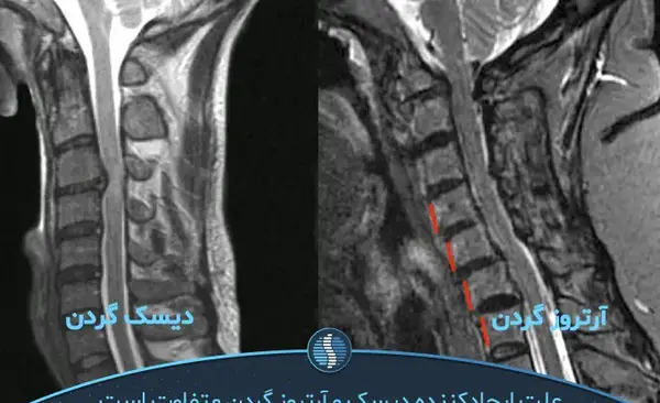 آرتروز گردن عکس ام ار ای دیسک گردن سالم