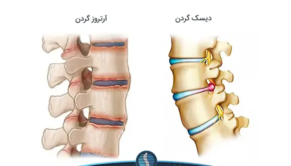 آرتروز گردن عکس ام ار ای دیسک گردن سالم