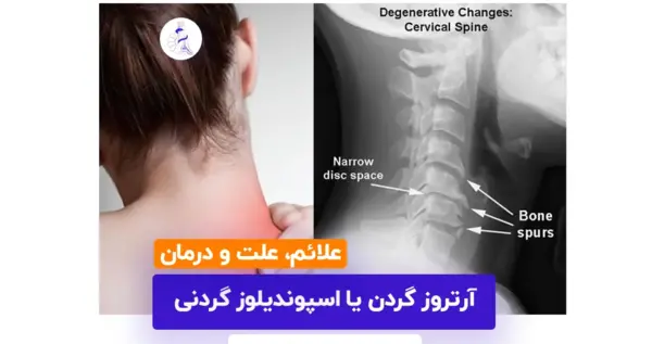 آرتروز گردن عکس ام ار ای دیسک گردن سالم