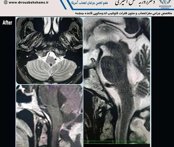 عکس ام ار ای مغز تومور دار