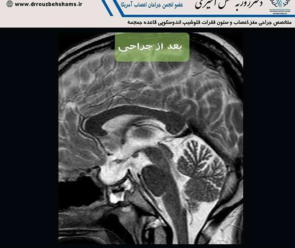 عکس ام ار ای مغز تومور دار