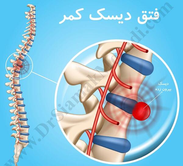 پارگی عکس ام ار ای دیسک کمر خفیف