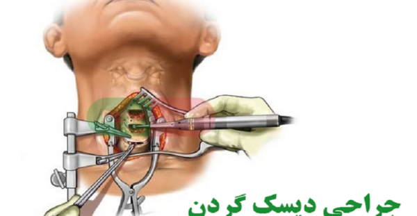 پارگی عکس ام ار ای دیسک کمر خفیف