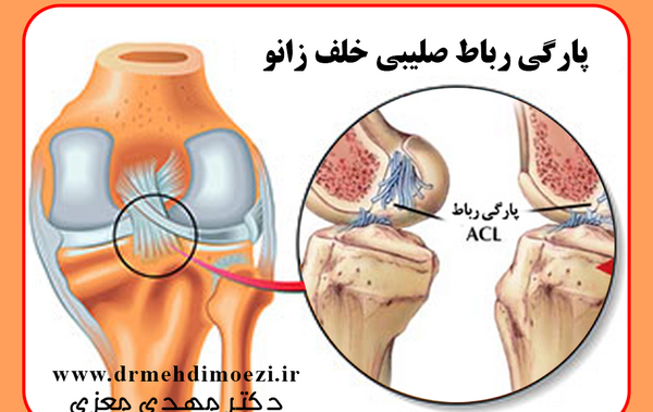 مینیسک عکس ام ار ای پارگی رباط صلیبی زانو