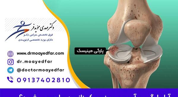 مینیسک عکس ام ار ای پارگی رباط صلیبی زانو
